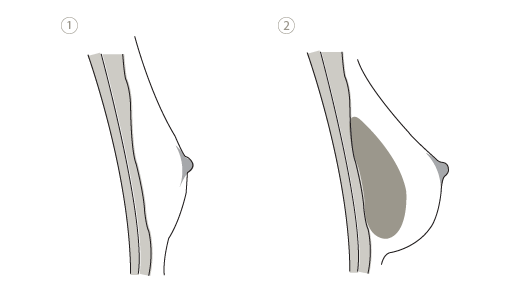 Brustvergrößerung mit Implantat über Brustmuskel, Plastische Chirurgie Leipzig, Dr. Wachsmuth & Dr. Völpel