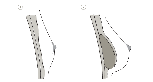 Brustvergrößerung mit Implantat unter Brustmuskel, Plastische Chirurgie Leipzig, Dr. Wachsmuth & Dr. Völpel